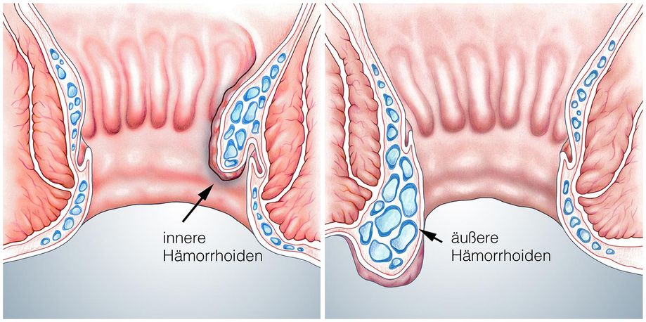 Hämorrhoiden